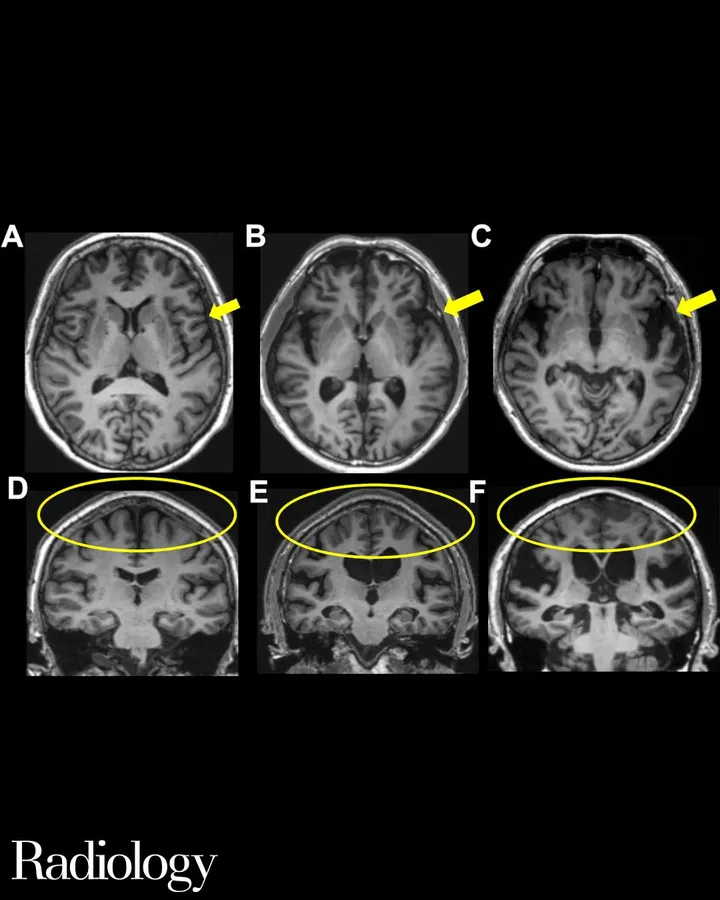 Radiology - Association of disproportionately enlarged subarachnoid space hydrocephalus fe