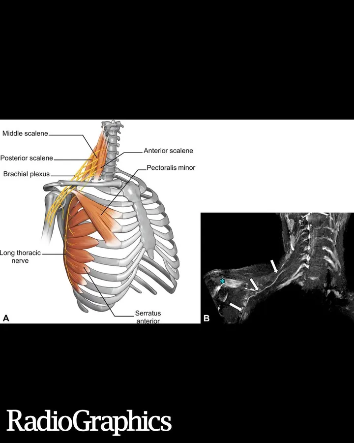 RadioGraphics - MR neurography of fine-caliber nerves: technical considerations and practi